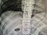 18:00 –
Reeducando é hospitalizado com dor no estômago e raio-x mostra minicelular no órgão