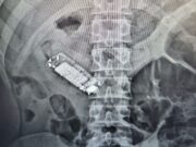 Detento é internado após engolir celular em cadeia em MT