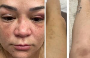21:23 –
Advogada presa por agressão diz que verdade será restabelecida e mostra supostos hematomas: "fiquei atordoada de tanta paulada"
